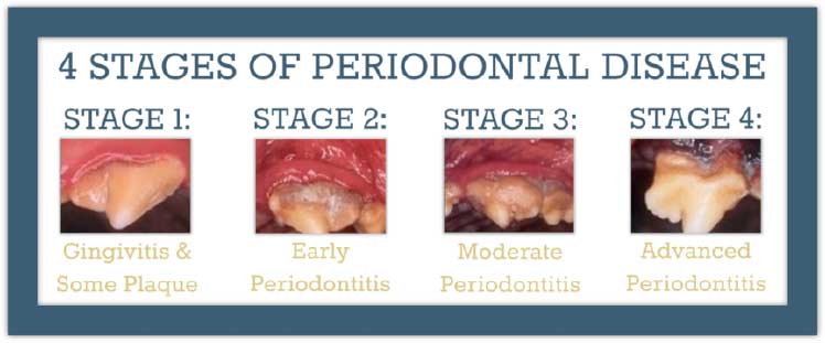 stages-of-periodontal-disease